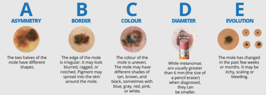 Skin Cancer
