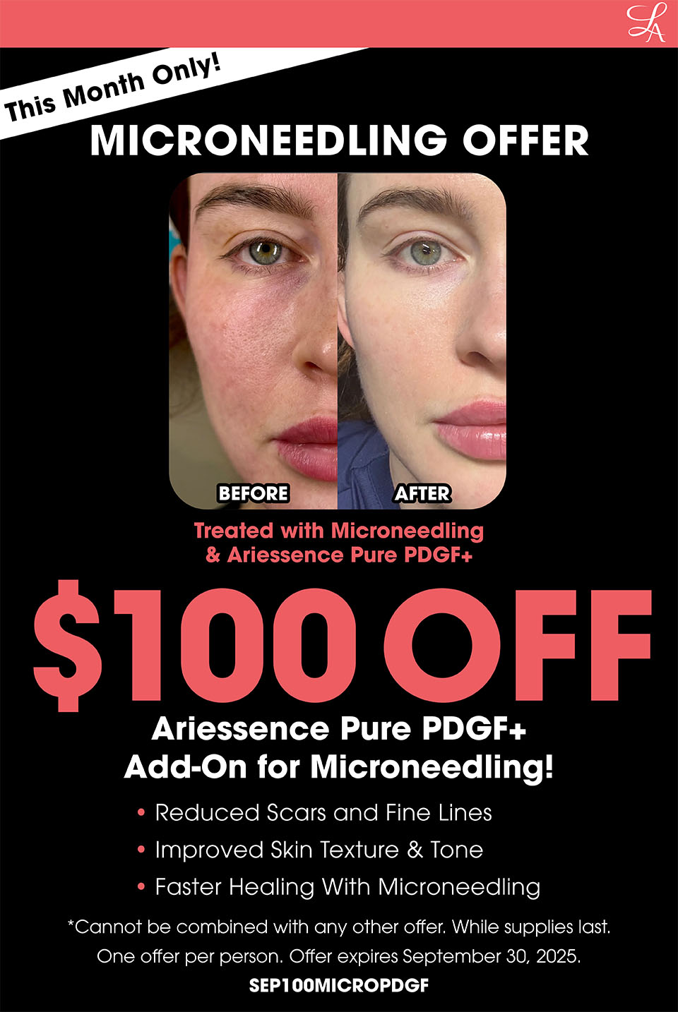 Microneedling Offer for September