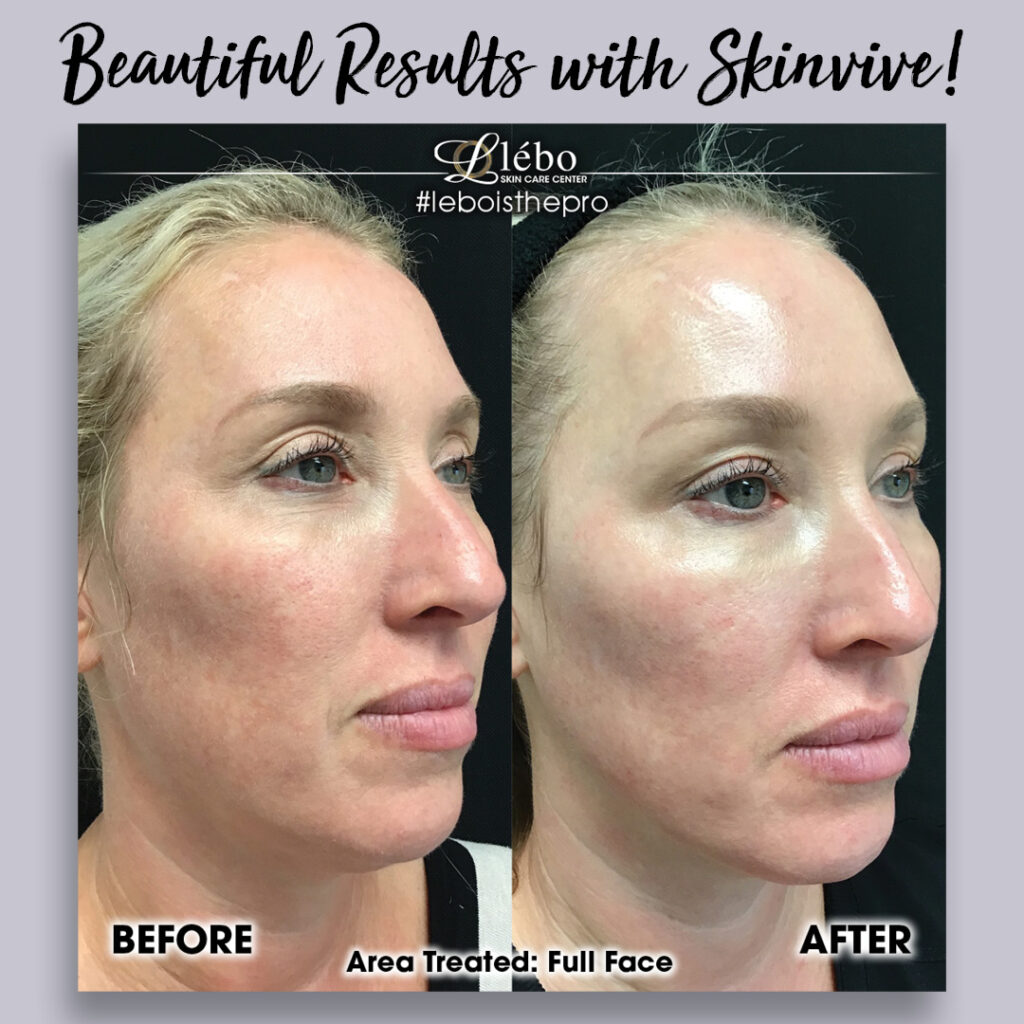 Skinvive Before and After