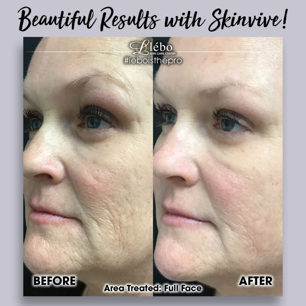 Skinvive Before and Afters