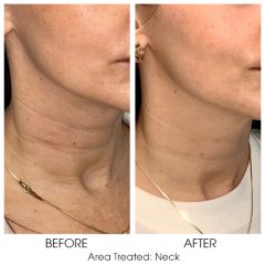 Sofwave patient before and after of neck