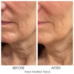 Sofwave patient before and after of neck