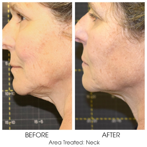 Sofwave patient before and after of neck