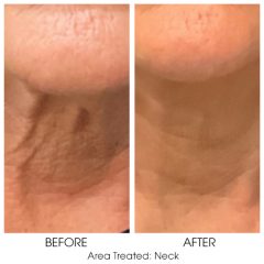 Sofwave patient before and after of neck