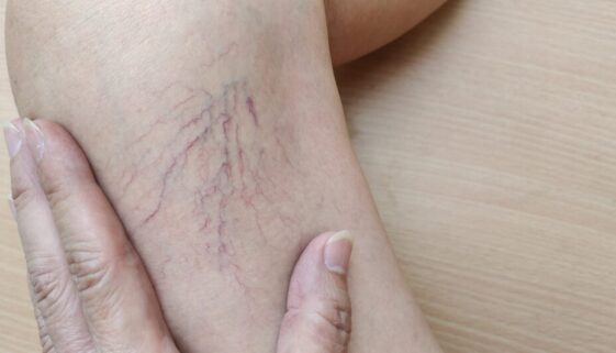Spider Vein Treatments