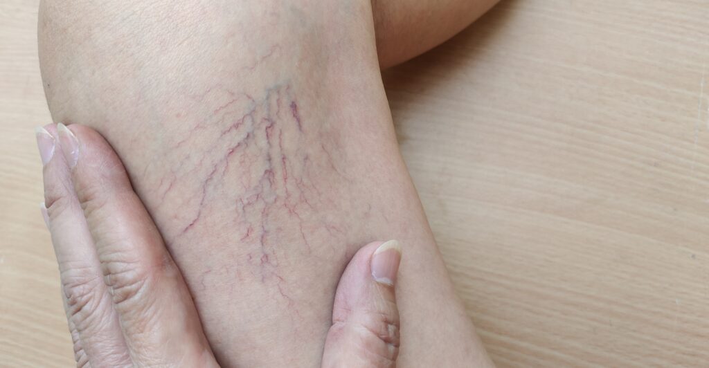 Spider Vein Treatments