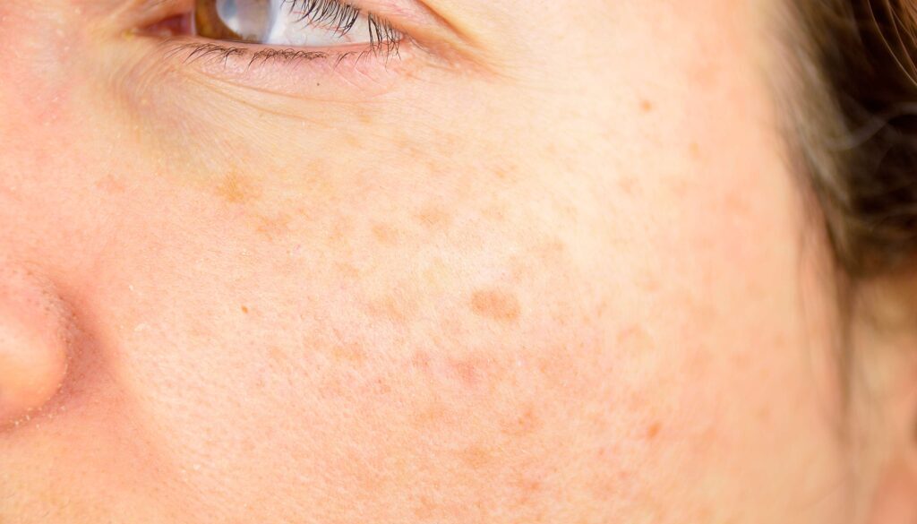 Sun Damage
