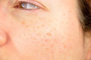 Sun Damage Sun Damage
