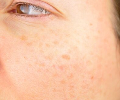 Sun Damage