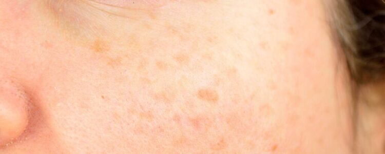 End of Summer Skin Check: How to Reverse Sun Damage and Protect Your Glow End of Summer Skin Check: How to Reverse Sun Damage and Protect Your Glow