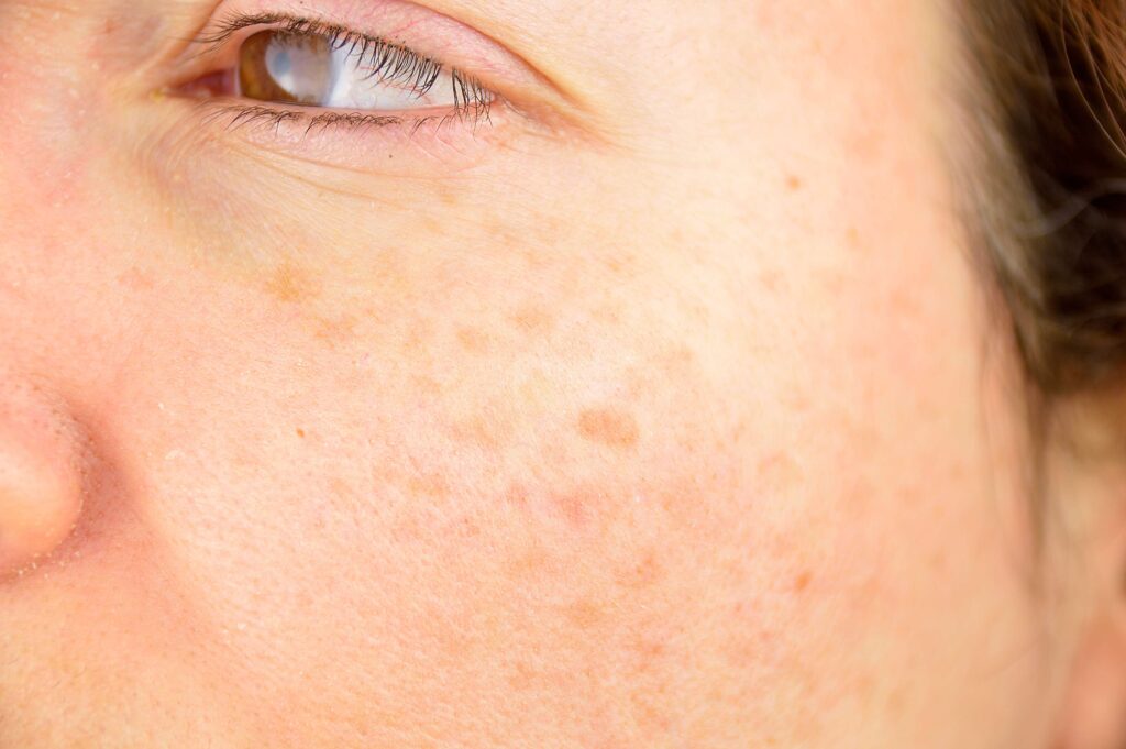 Sun Damage