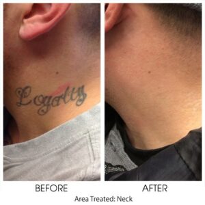 TATTTOO REMOVAL