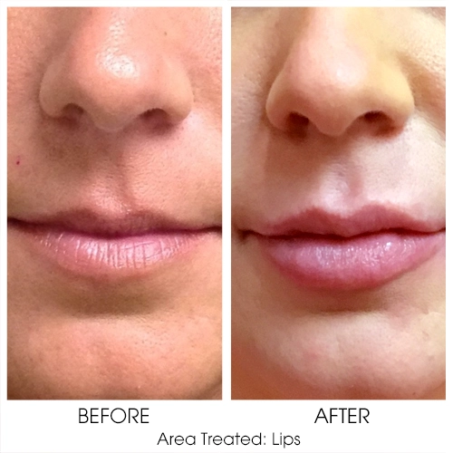 Lip Flip Before & After