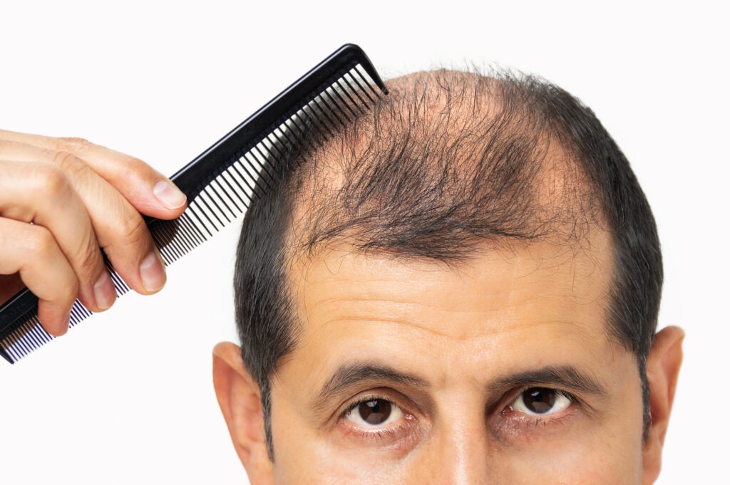 Hair Loss