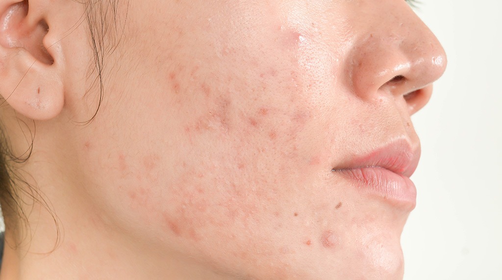 Example of woman with acne