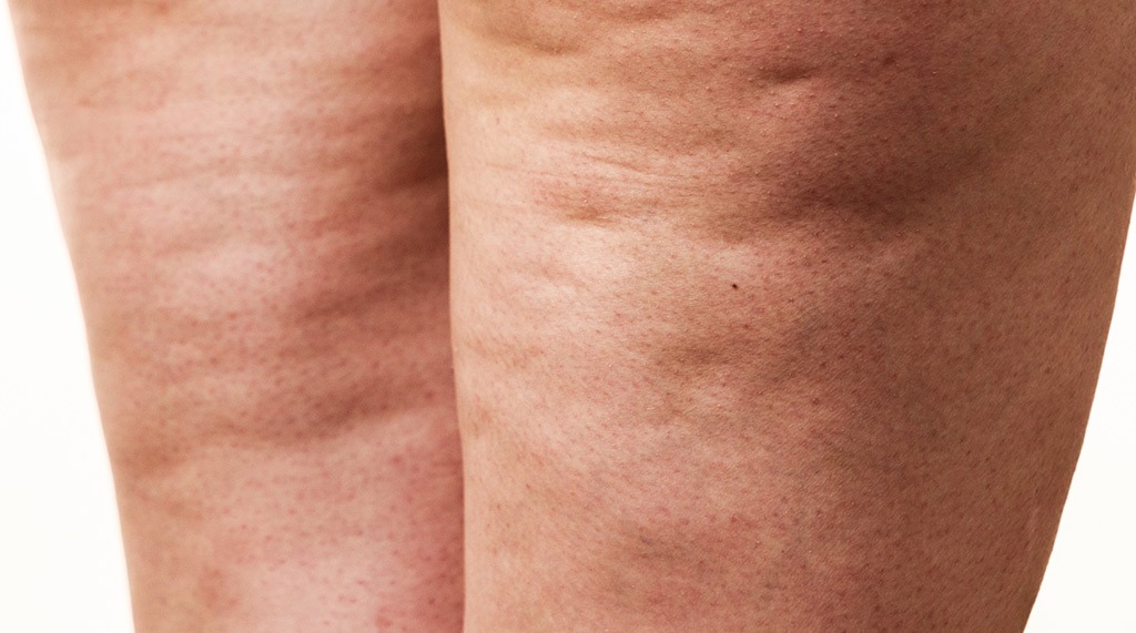 Celluliter hur blir man av med?