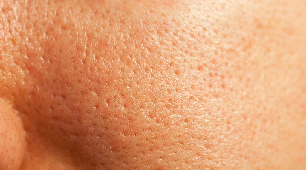 large pores