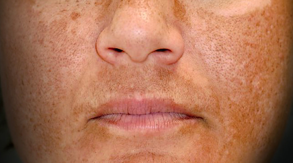 melasma treatments