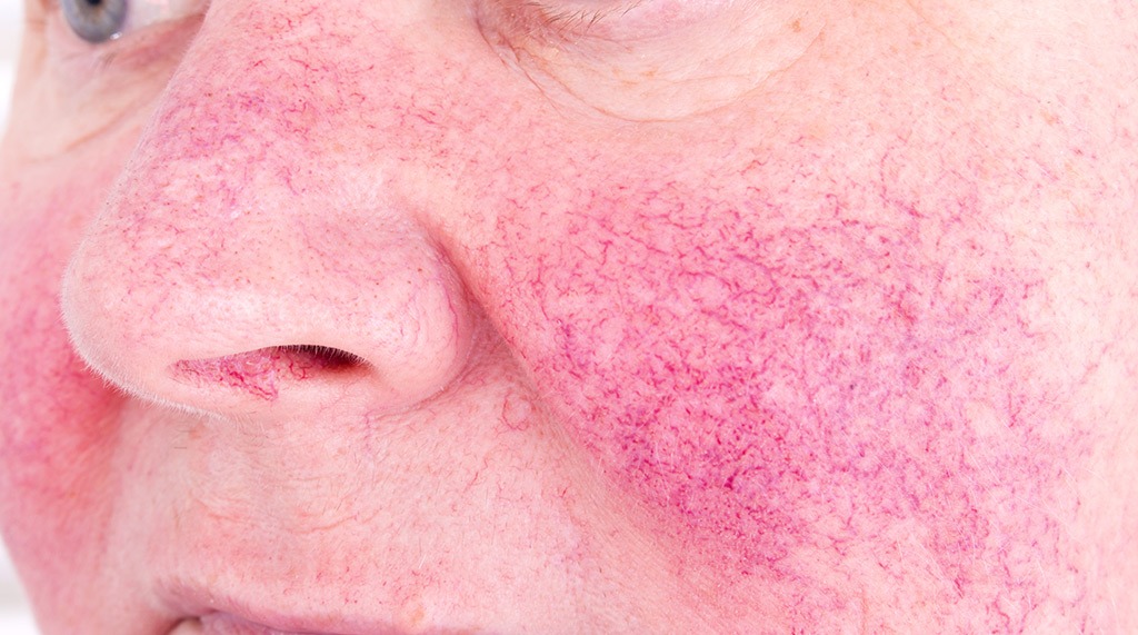 Rosacea 