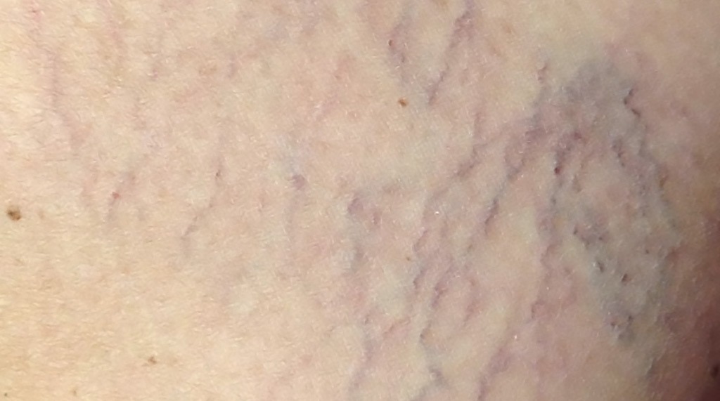 Spider Veins