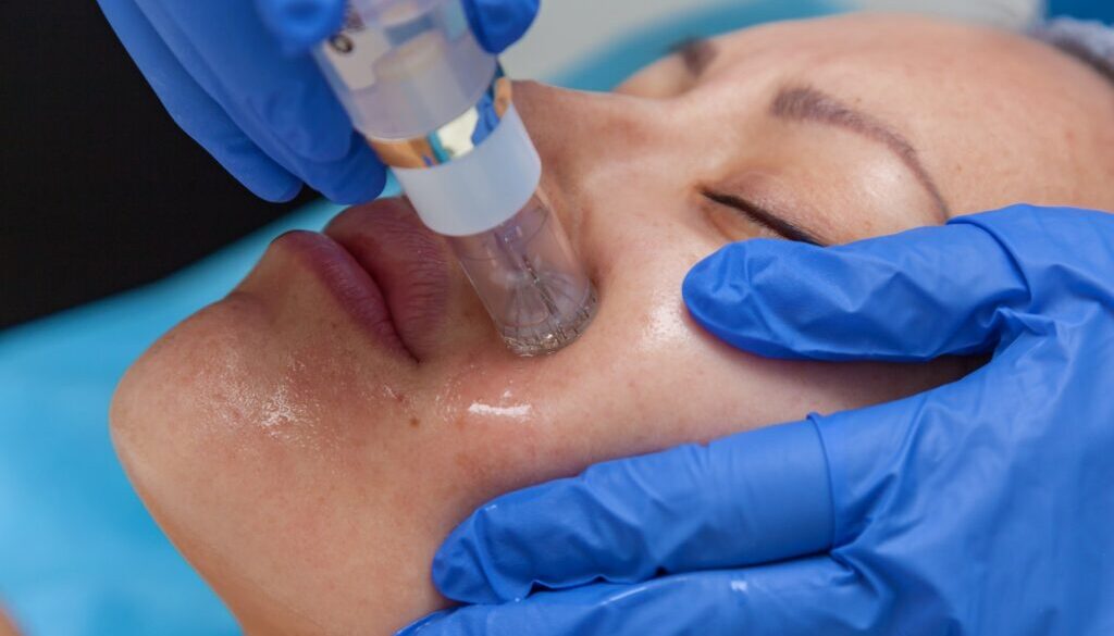 microneedling