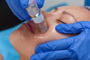 microneedling