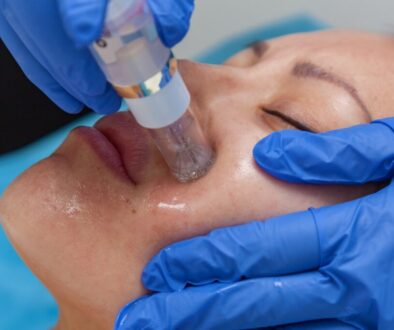 microneedling