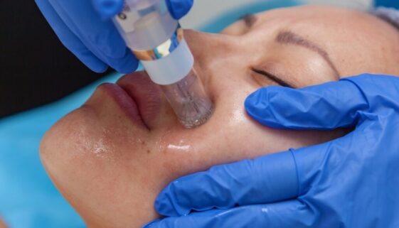 microneedling