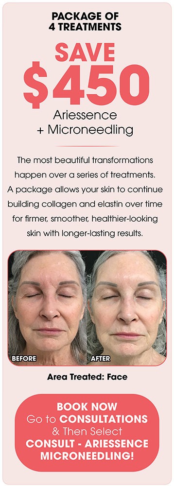 Ariessence + Microneedling 4 Treatments