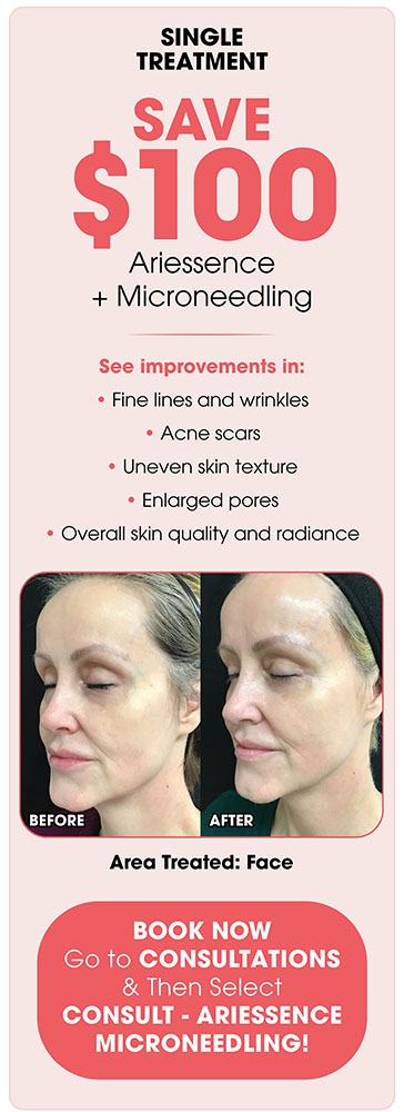 Ariessence + Microneedling Single