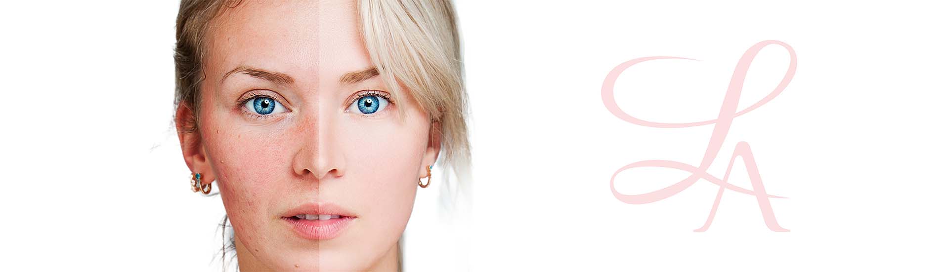 Acne header with before and after of woman and Lébo logo