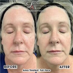 SkinVive Before After