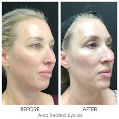 Sofwave for eyelids