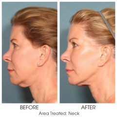 Sofwave patient before and after of neck