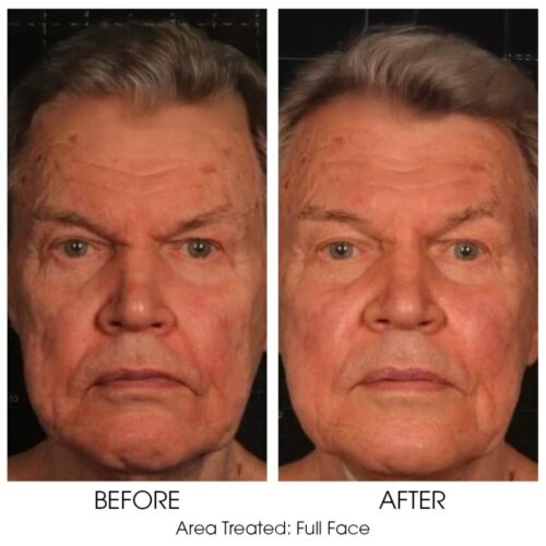 thumbnail_BnA_For_sofwave02_v2 Sofwave for Men Skin Tightening