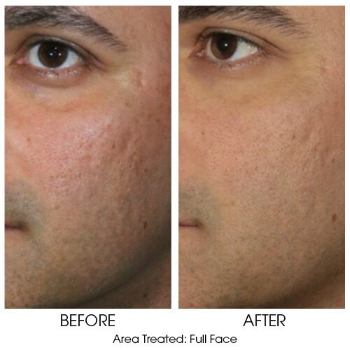 thumbnail_BnA_For_sofwave1 Sofwave for Acne Scarring